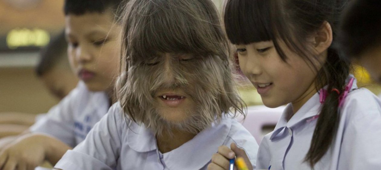 La niña más peluda del mundo depiló su cara y así luce ahora