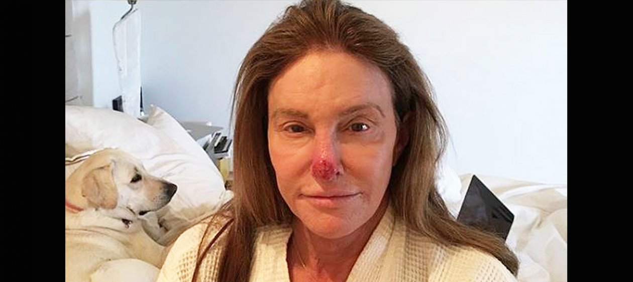 Caitlyn Jenner asume cáncer de piel con chocante imagen