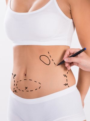 Las 6 cosas que debes saber antes de someterte a una cirugía plástica