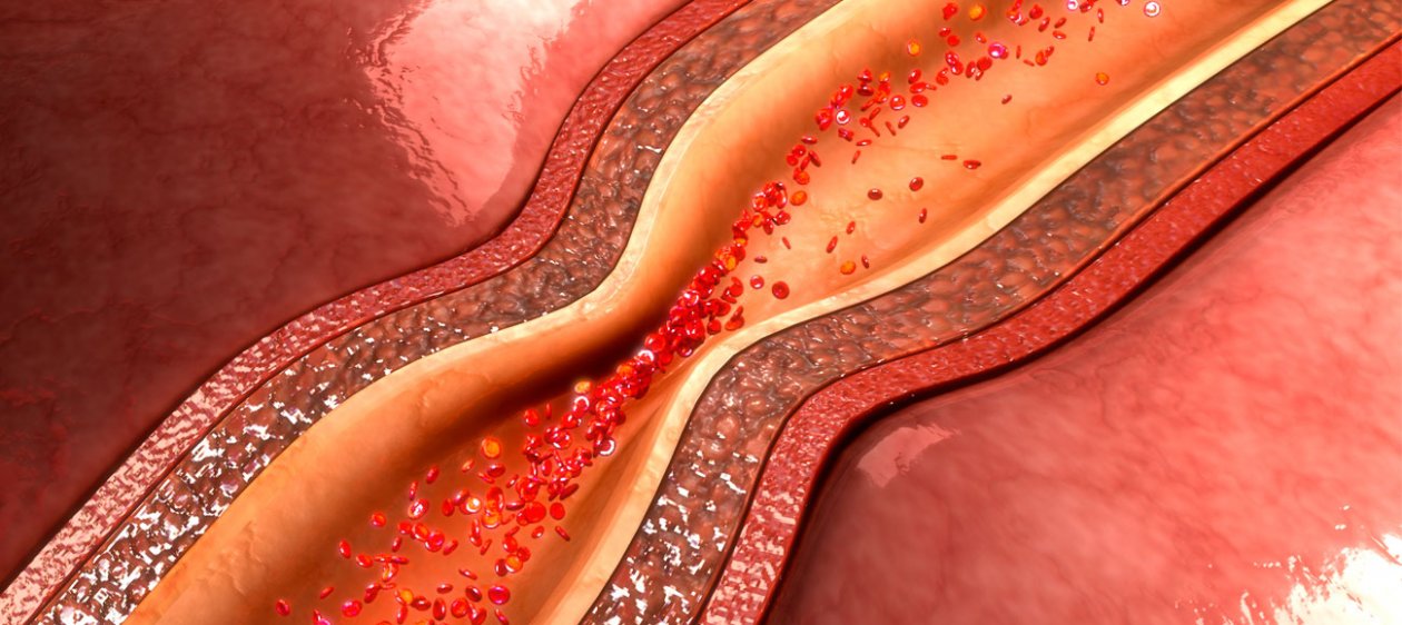 Día Mundial de la Hipertensión: Roncar afecta tu presión arterial