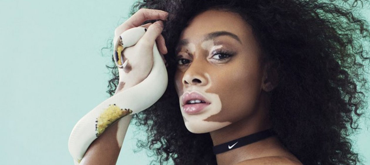 Winnie Harlow, la primera modelo con vitiligo que se desnuda