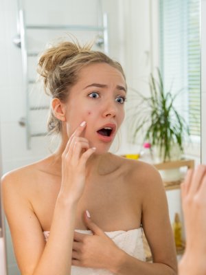 ¿Por qué tu acné no desaparece en la adultez? Estas razones podrían explicarlo