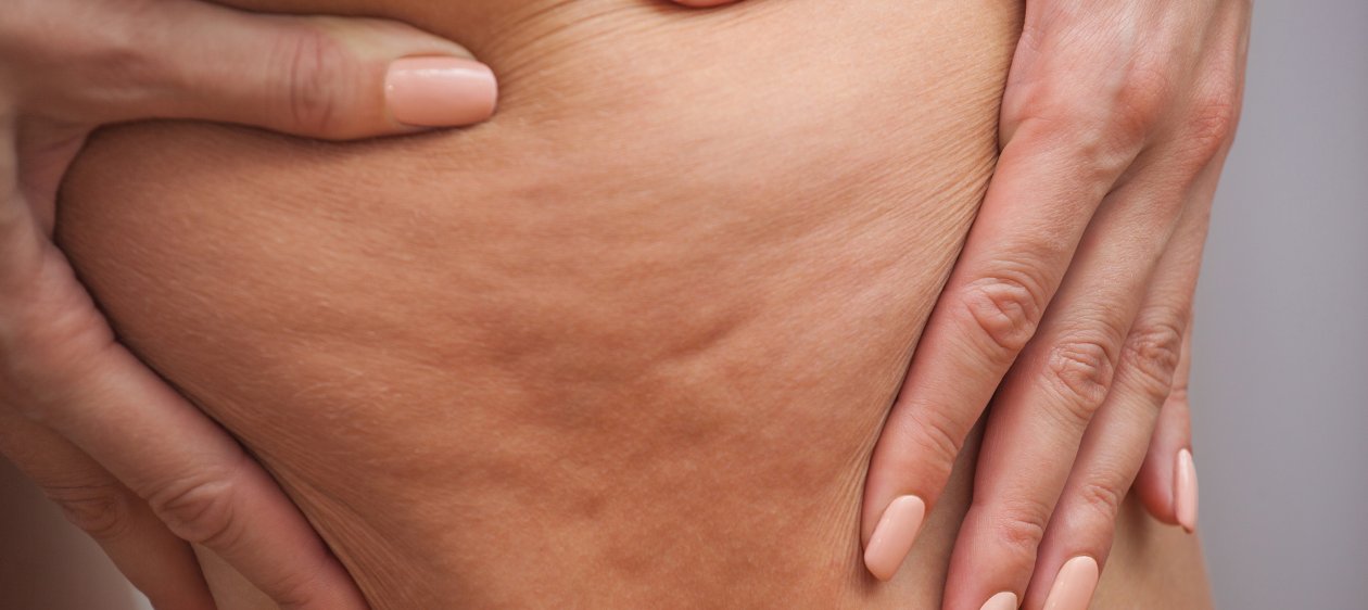 Estos son los 5 mitos más recurrentes sobre la celulitis