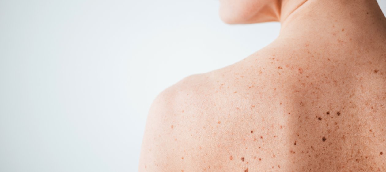 ¡Prevención! Aprende a identificar el cáncer por melanoma