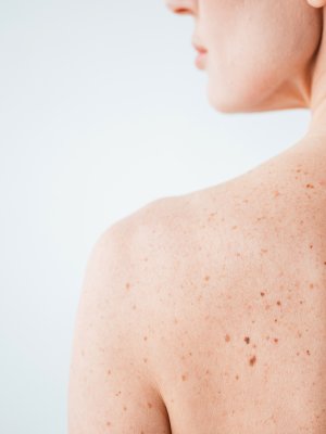 ¡Prevención! Aprende a identificar el cáncer por melanoma