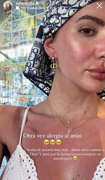 Aylén Milla mostrando su rostro y hombros irritados