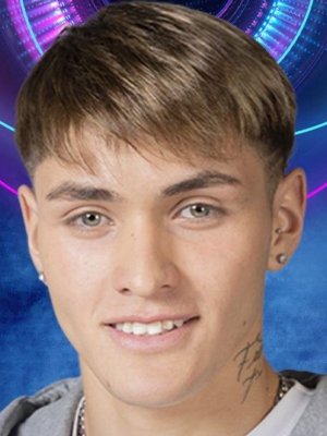 Hans Valdés mostró antes y después de someterse a retoque estético