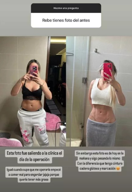 antes y después de la ciirugía de lipoescultura