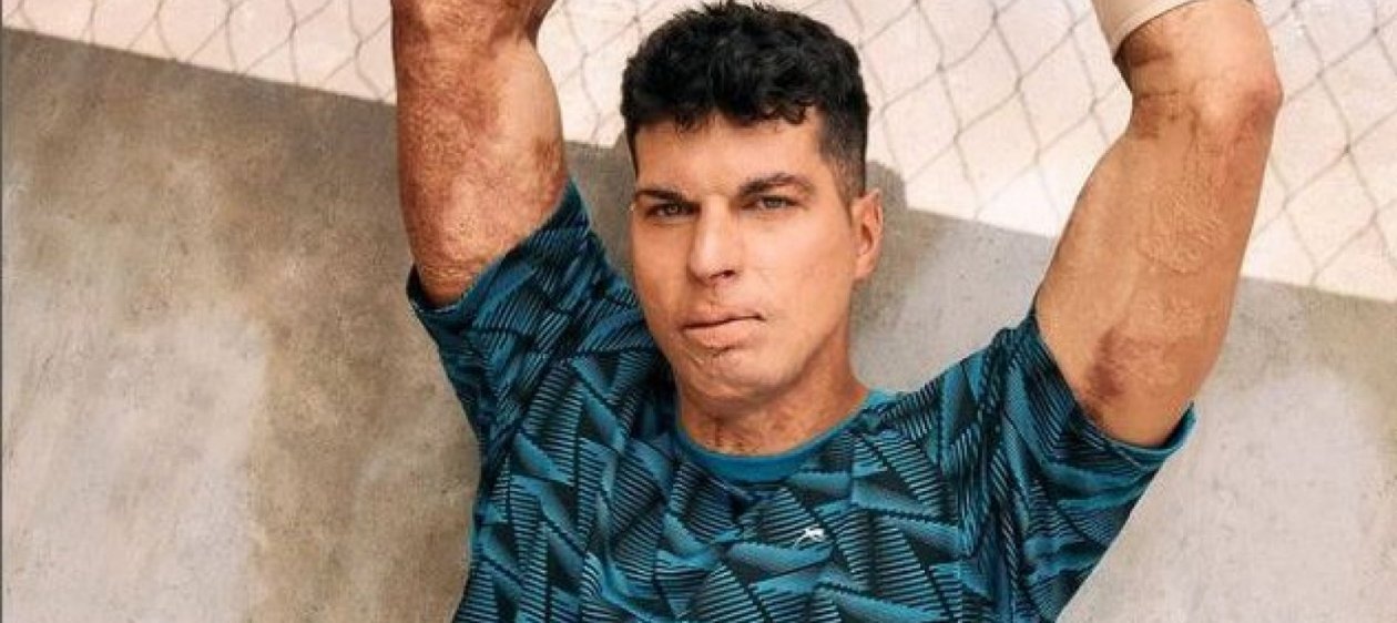 Ignacio Lastra recordó el grave accidente en el que terminó con 90% de su cuerpo quemado