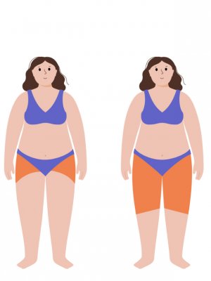 Lipedema: la enfermedad silenciosa que afecta a miles de mujeres y suele confundirse con obesidad